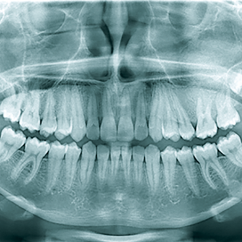Обширная фиброзная дисплазия левой верхней челюсти. Случай из практики