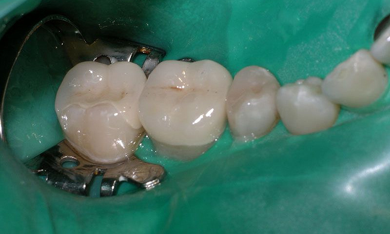 Зачем нужен коффердам при стоматологическом лечении?