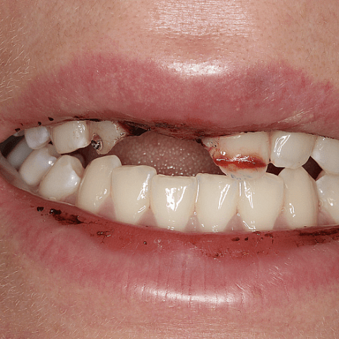 Косметическая и функциональная реабилитация после стоматологической травмы