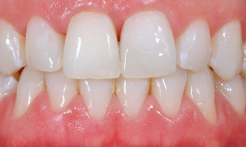 Косметическая и функциональная реабилитация после стоматологической травмы