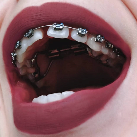 Щербинка между зубами – привлекательная особенность или аномалия?