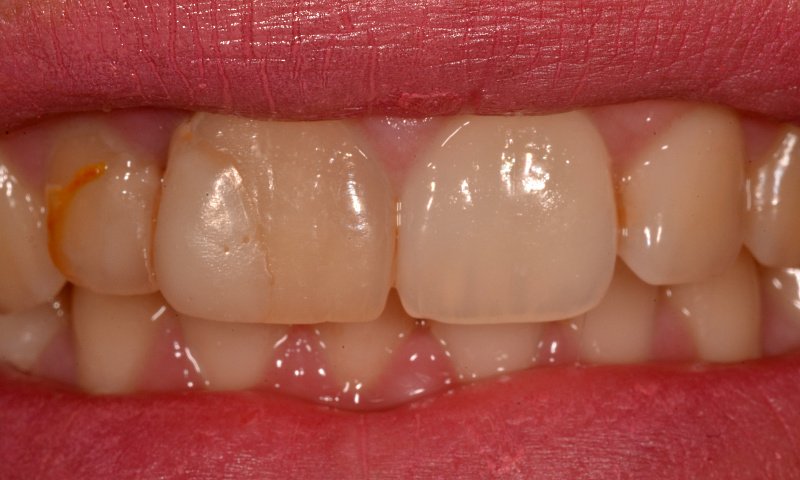 Причины дисхромии зубов