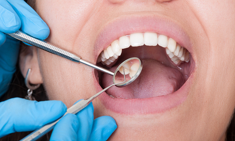 Герметизация фиссур зубов