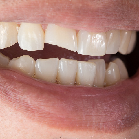Перелом зуба — симптомы и методы лечения
