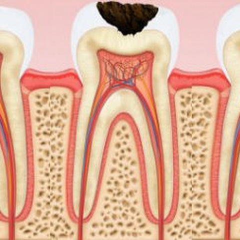 Внутренний и внешний кариес: что страшнее?