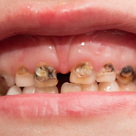 Дефекты эмали зубов