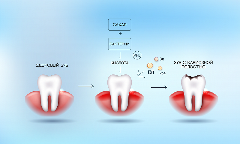 Флюороз зубов - что такое флюороз зубов: причины, методы лечения, признаки
