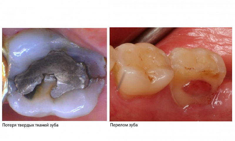 Почему восстановление зуба коронкой часто применяется для вторых моляров?