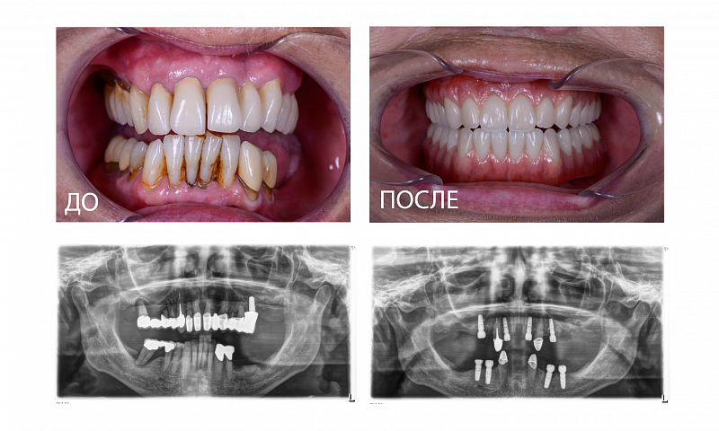 Комплексная реставрация при сильно поврежденном зубном ряде