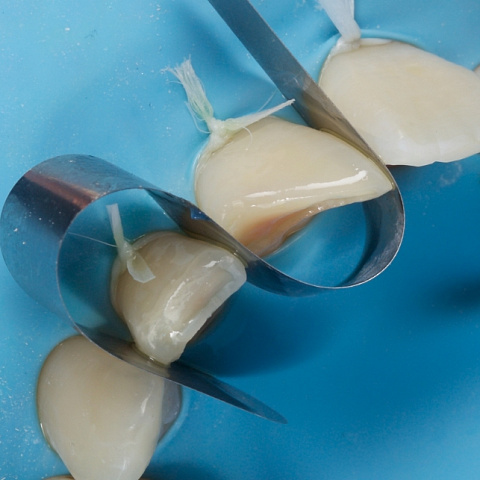 Лечение неосложненных переломов коронок зубов