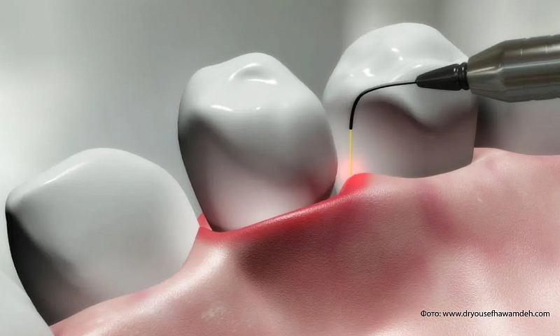 Лазерное лечение в стоматологии