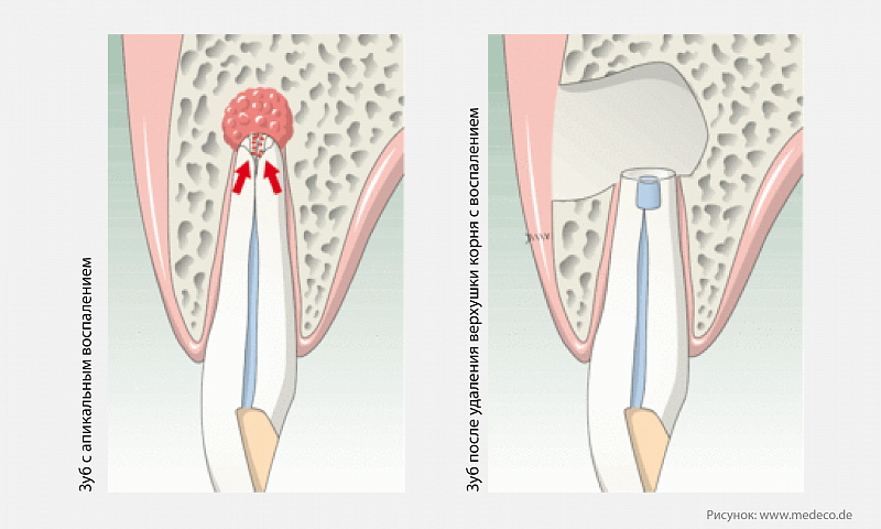 Апикальная хирургия в стоматологии