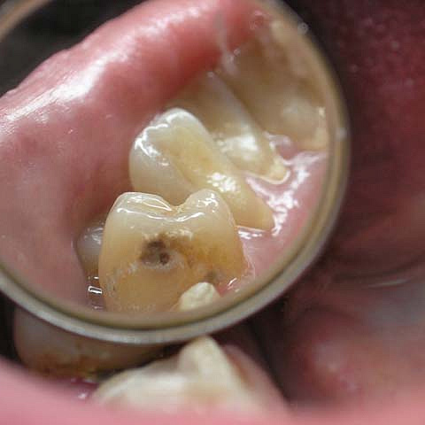 Профилактика кариеса и заболеваний слизистой оболочки полости рта