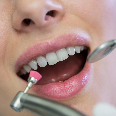 Что такое полировка зубов
