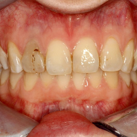 Эстетическая реставрация депульпированного переднего зуба