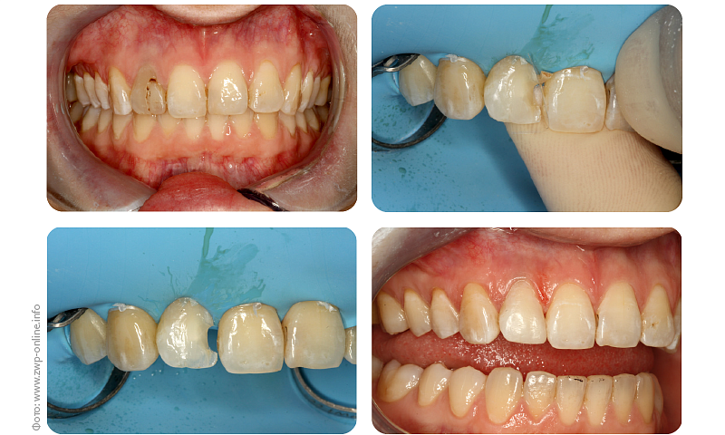 Эстетическая реставрация депульпированного переднего зуба