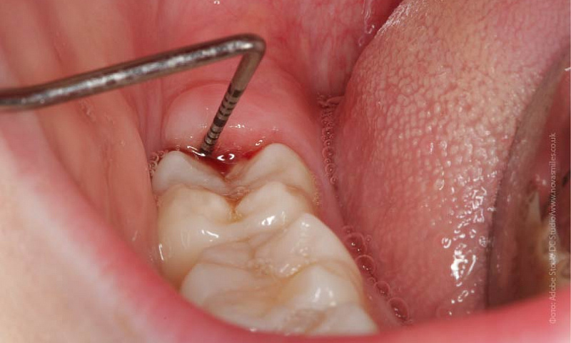 Что такое перикоронит зуба — причины, симптомы и лечение