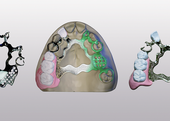 Цифровое моделирование бюгельного протеза: Exocad PartialCad