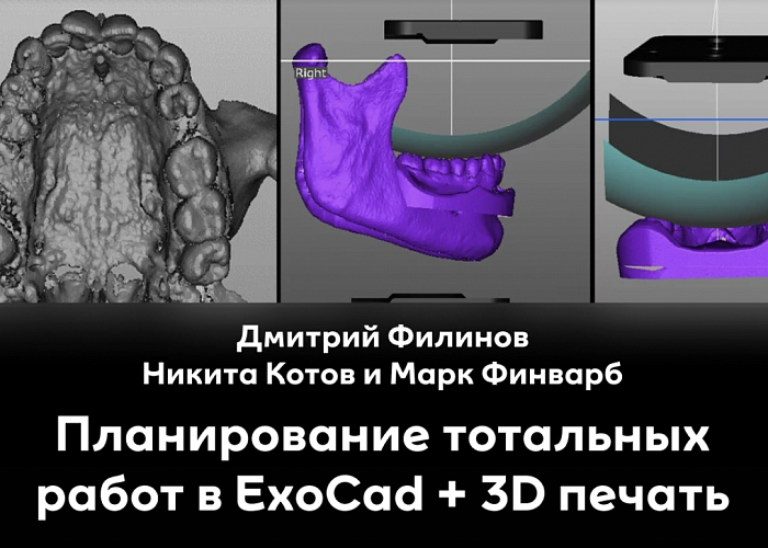 Планирование тотальных работ в ExoCad + 3D печать. Работа на имплантатах в цифровом протоколе.