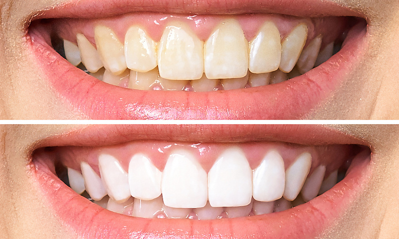 Отбеливание зубов - виды и особенности процедуры