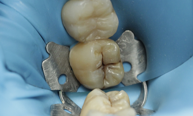 Реставрация зуба по ключу. Преимущества и особенности метода. 