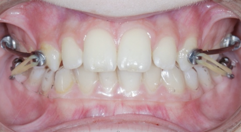 Эффективность современного двухэтапного ортодонтического лечения дистальной окклюзии у подростков