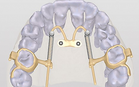 Цифровое планирование ортодонтических мини-имплантатов и моделирование аппаратов с кортикальной опорой  по концепции pin-first