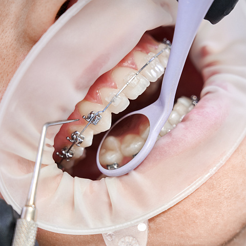 Выравнивание зубов и исправление прикуса без брекетов