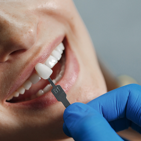 Вредны ли виниры для зубов: факты и мифы