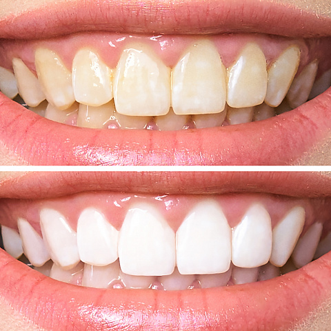 Как сохранить белизну зубов после отбеливания: уход и профилактика