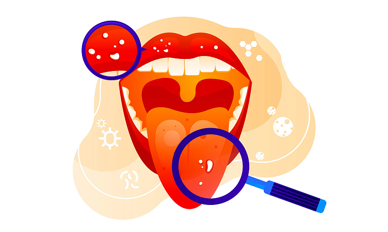 Заболевания слизистой оболочки полости рта: Симптомы, причины и современные методы лечения
