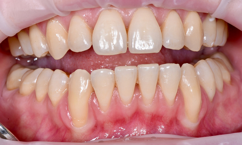 M-СAF + LAST. Рецесии на нижней челюсти после ортодонтического лечения