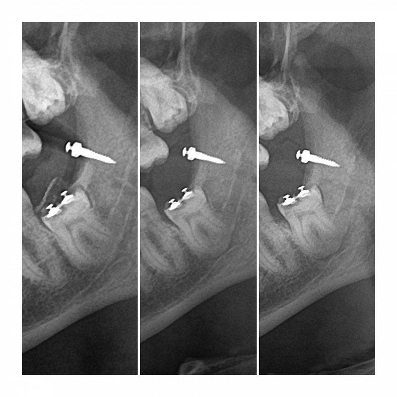 Экструзия зуба мудрости или как избежать травмы нижнелуночкового нерва. 