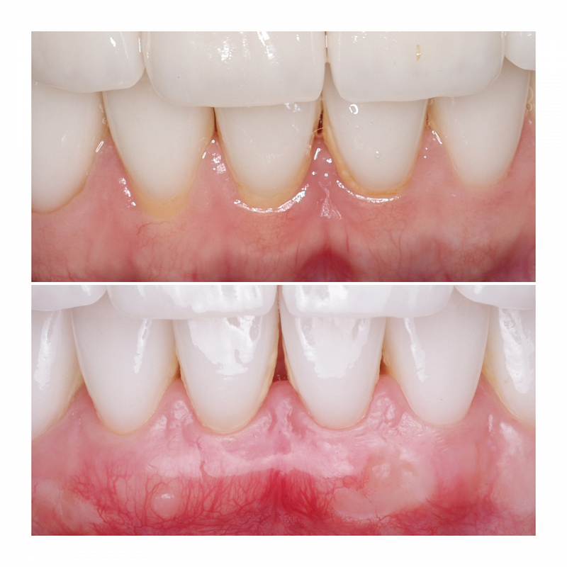 Закрытие рецессий десны после фиксации виниров