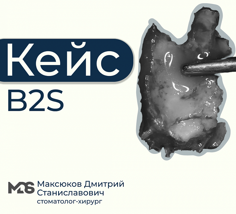 B2S + имплантация
