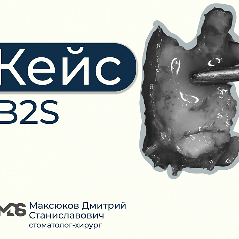 B2S + имплантация