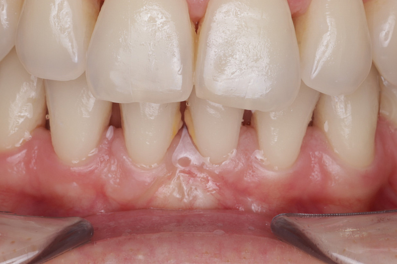 Закрытие рецессии десны для профилактики дальнейшего оголения корней