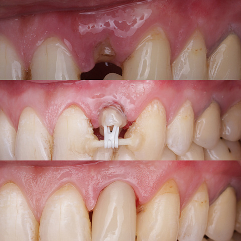 Лопнул корень зуба. Удаляем или как сохранить?