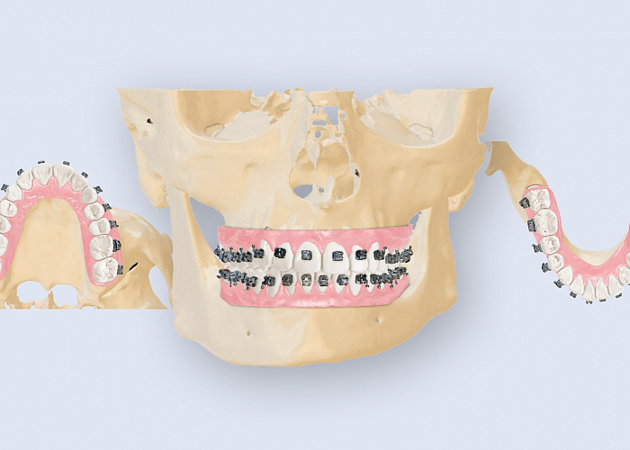 Непрямая фиксация брекетов