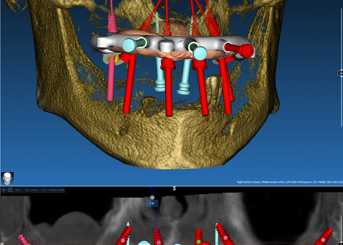 Тема курса: «Разборные хирургические шаблоны в RealGUIDE: поэтапное моделирование накостных, комбинированных, металлических шаблонов и конструкций для