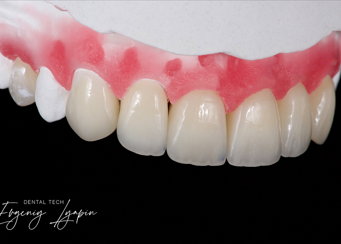 «Авторский курс от Евгения Ляпина по теме: Изготовление циркониевых коронок по концепции BOPT. На примере масс e.max и creation»