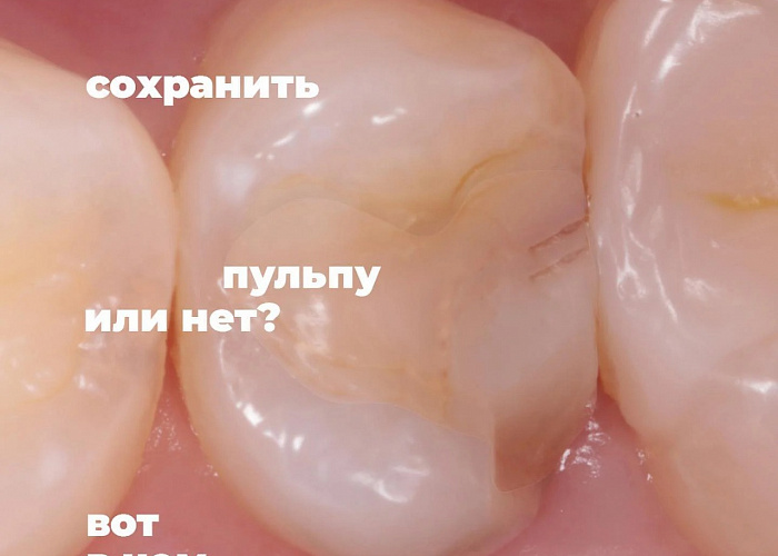 «Художественная и функциональная реставрация. Жевательная + фронтальная группы зубов»