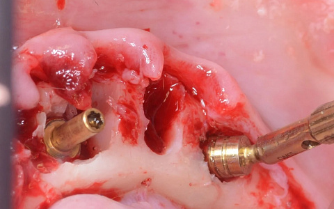 «Дентальные протоколы работы с имплантатами. Взаимодействие хирурга и ортопеда»