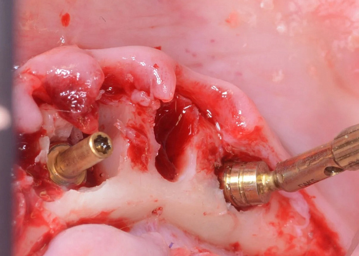 «Дентальные протоколы работы с имплантатами. Взаимодействие хирурга и ортопеда»