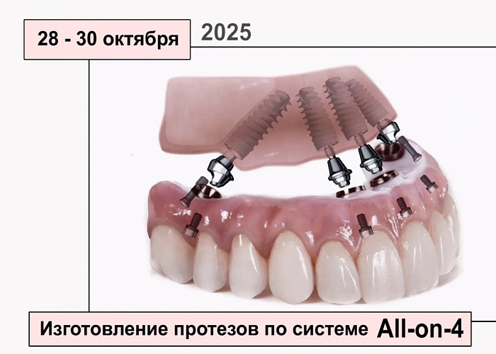 Концепция «All-on-four». Создание имплантационных протезов на винтовой фиксации для немедленной нагрузки.