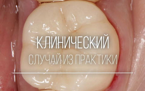 «Инструментальная обработка корневых каналов»