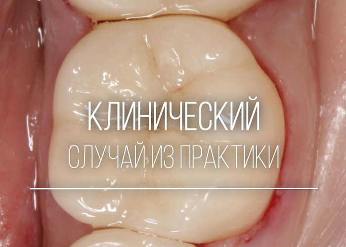 «Инструментальная обработка корневых каналов»