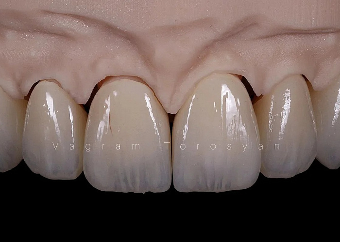 «Симметрия формы и цвета. Живая эстетика и индивидуализация в полно анатомических конструкциях из диоксида циркония»