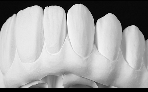 «Планирование тотальных работ в ExoCad + 3D печать. Работа на имплантатах в цифровом и мануальном протоколе»