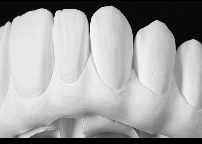 «Планирование тотальных работ в ExoCad + 3D печать. Работа на имплантатах в цифровом и мануальном протоколе»